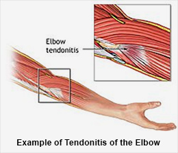 Treatment for Tendonitis
