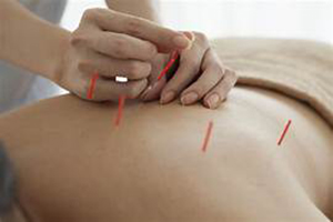 st. petersburg acupuncture treatments